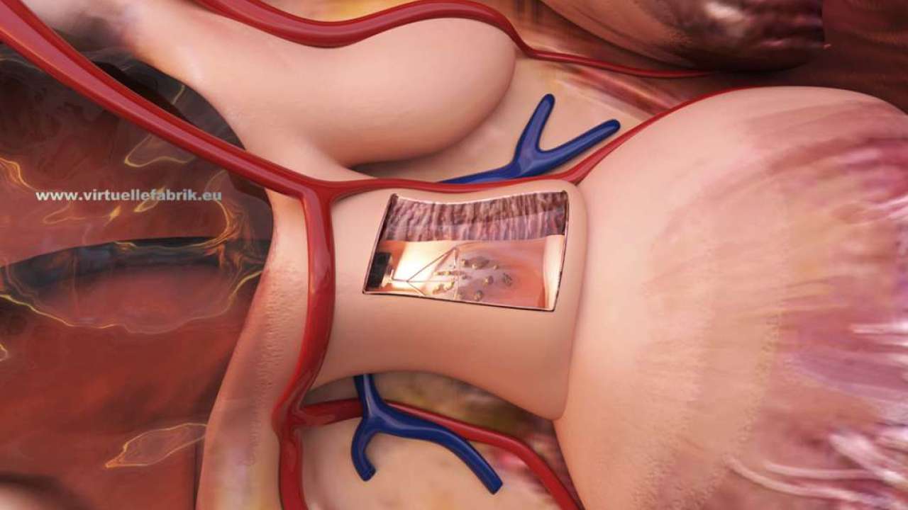 Visualisierung Medizintechnik Niere