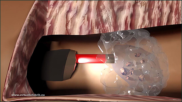 3D Animation für Nierenstein Operation