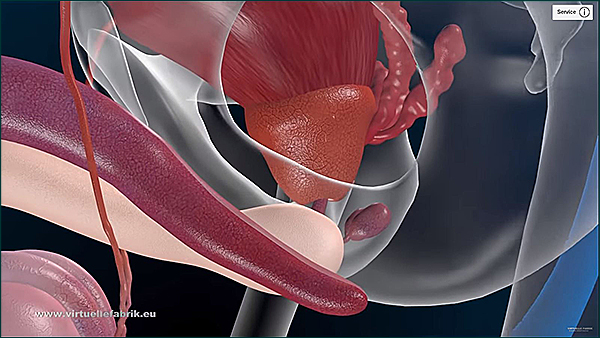 3d animation prostata-operation